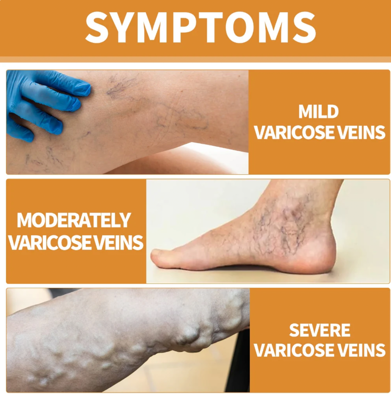 FlexoDerm Varicose Vein Relief Spray (BUY 1 GET 2 FREE 🎁)