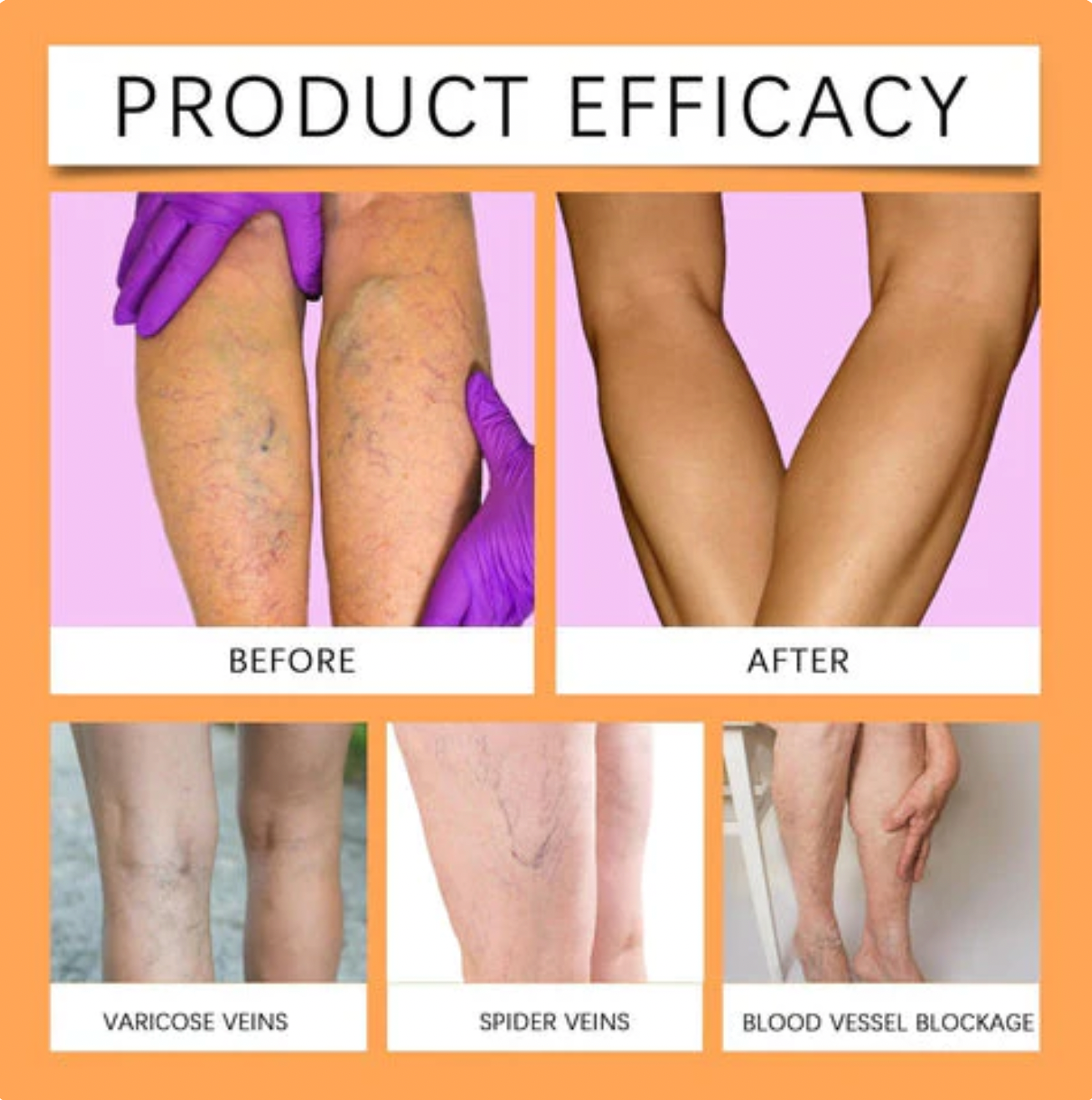 FlexoDerm Varicose Vein Relief Spray (BUY 1 GET 2 FREE 🎁)